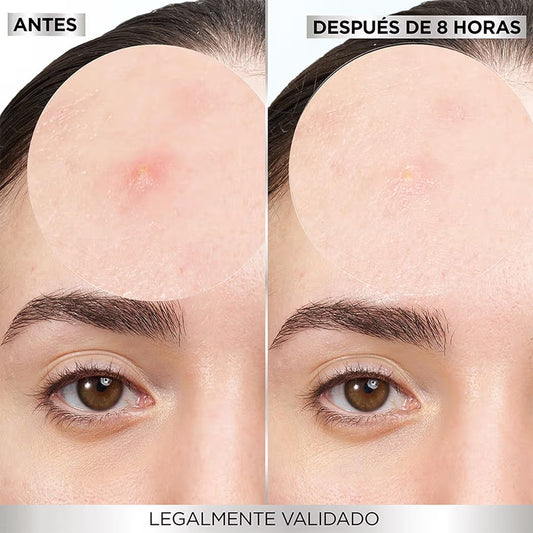 Parches para piel con tendencia al acné que reducen las imperfecciones en 8 hrs. Clínicamente Probado