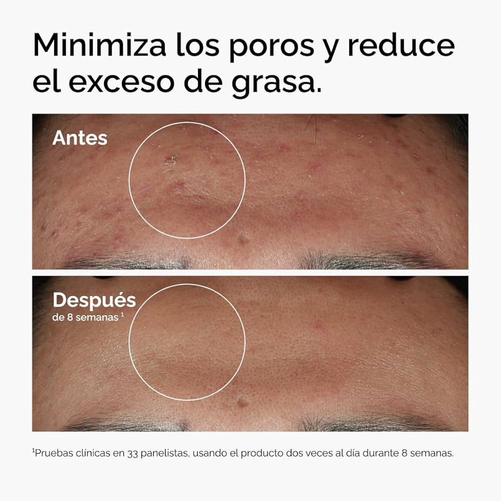 Niacinamide ,10% + Zinc 1%, Suero para Imperfecciones suaviza e ilumina.