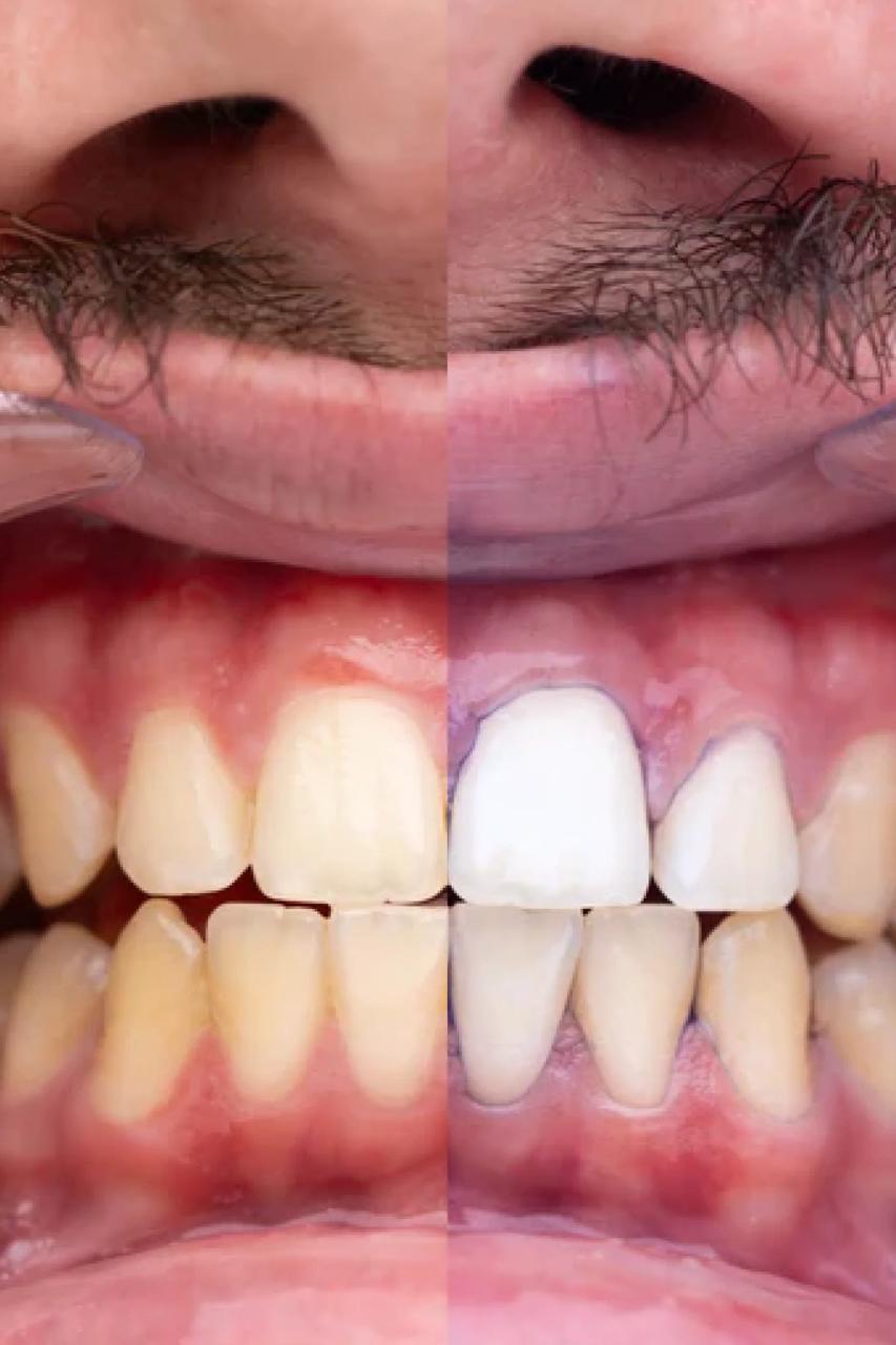 PURPLE V34 - Pasta Blanqueadora Dental