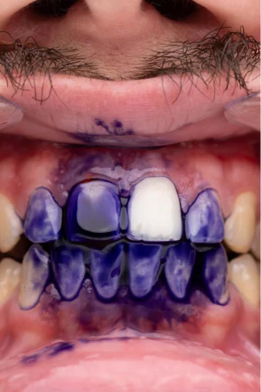 PURPLE V34 - Pasta Blanqueadora Dental